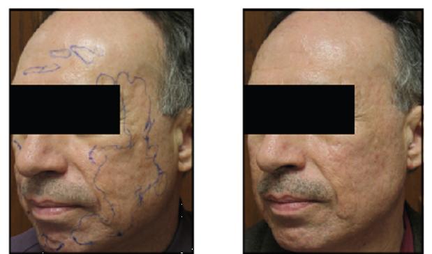 Laser Treatment of Scars